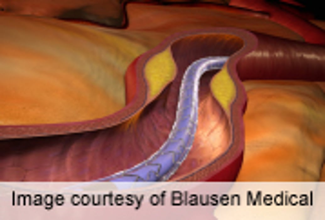Drug-Eluting Stents Offer No Advantage for A-Fib Patients