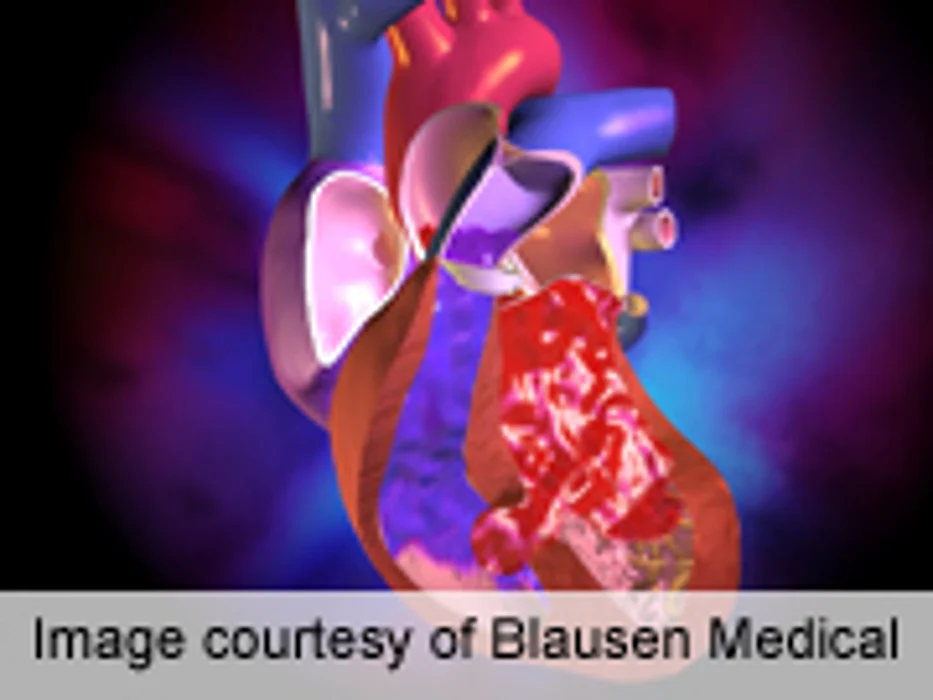 Risk Factors ID'd for SCA in Heart Defect Repair Survivors
