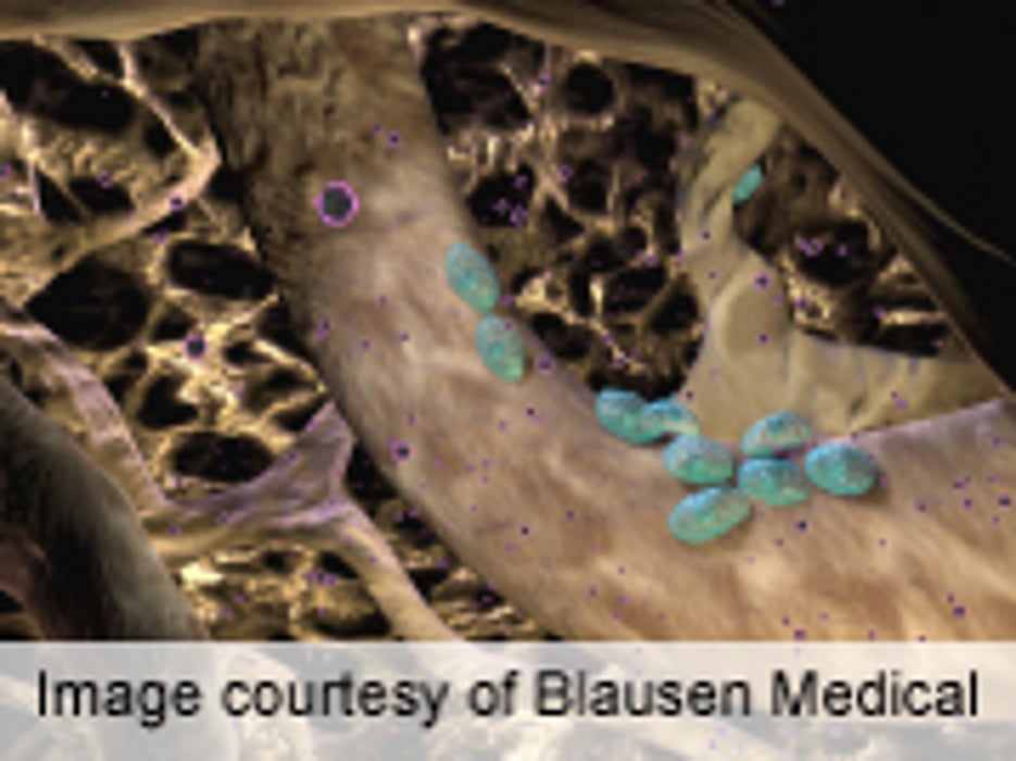Epidural Steroid Injection Impairs Hip Bone Density