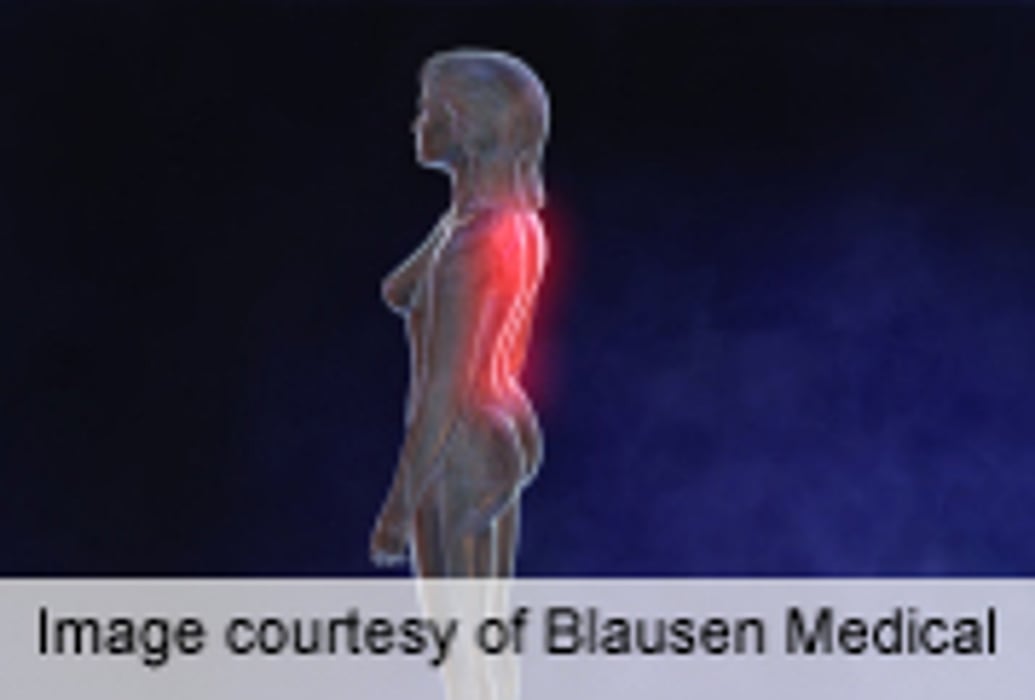 Brain Stimulation Improves QoL in Fibromyalgia Patients