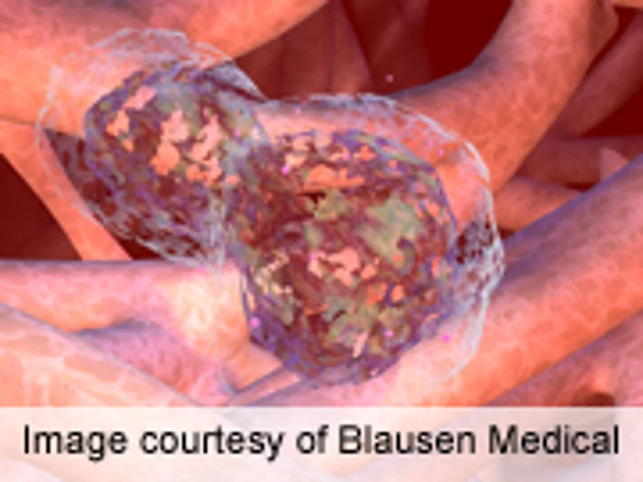 Accidental Exposure Causes Most Reactions in Allergic Infants
