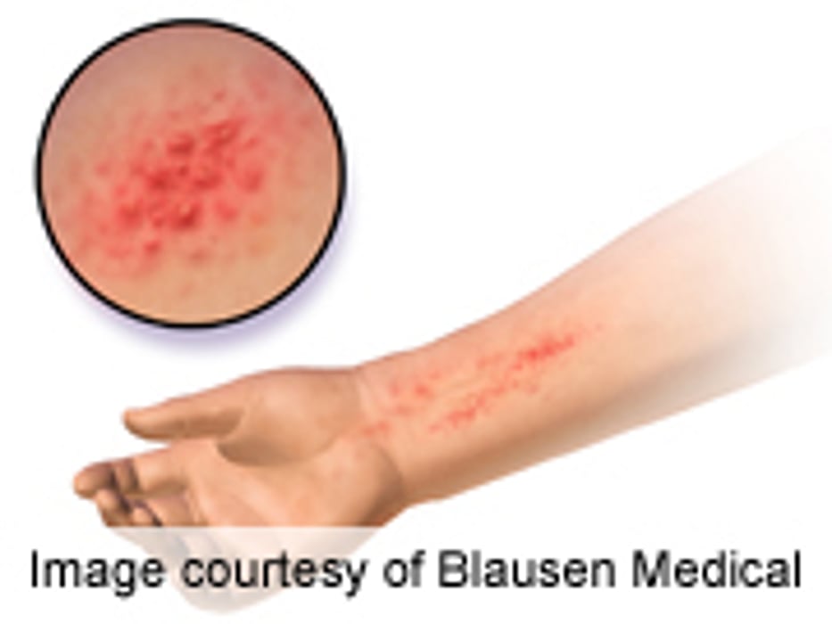 Azathioprine May Benefit Pediatric Atopic Dermatitis