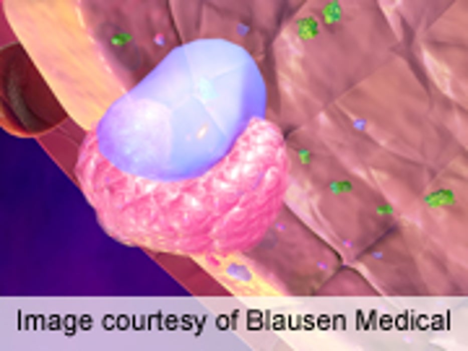 ENDO: Gene-Expression Assay IDs Suspicious Thyroid Nodules