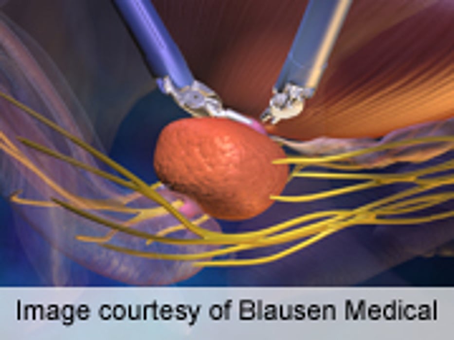 Fewer Positive Margins With Robot-Assisted Prostatectomy