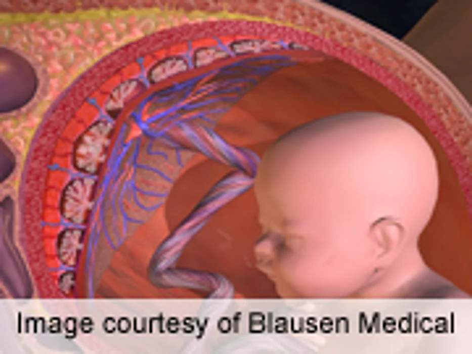 Fetal Hemoglobin Glycation May Reflect Hyperglycemia in Utero