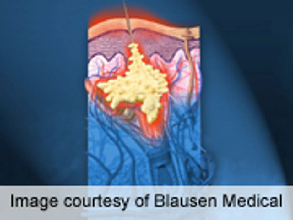 Study IDs Risk Factors for Severe Hidradenitis Suppurativa