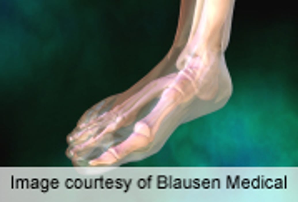 Forefoot Joints Don't Improve 28-Joint Count Measurement