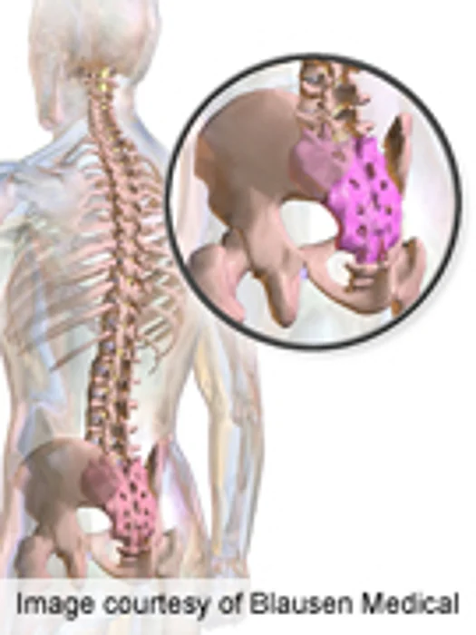 Curettage Alone Not Advised for Sacral Giant Cell Tumors