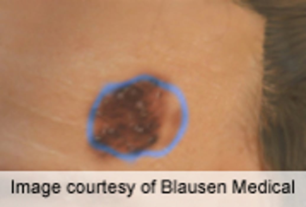 Web-Based Course Improves Ability to Detect Skin Cancer
