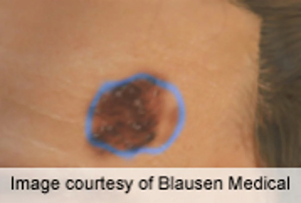 Adding Elesclomol to Paclitaxel for Advanced Melanoma Studied
