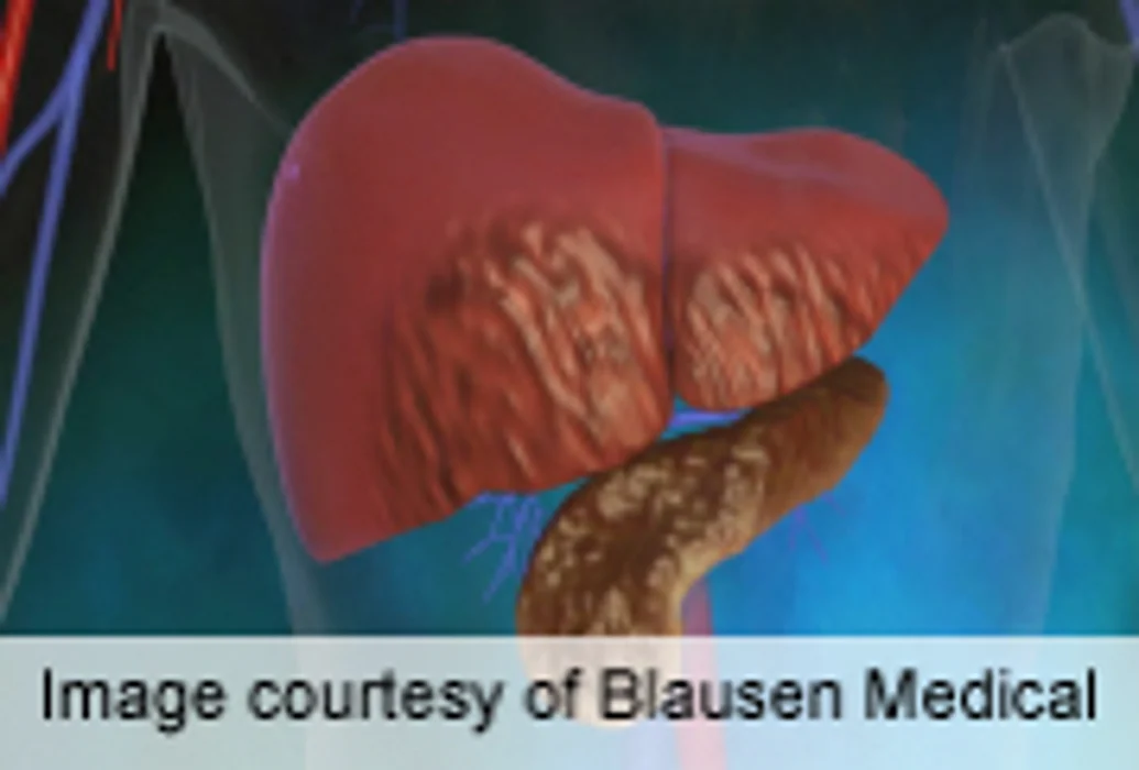 Prevalence of Familial Pancreatic Cancer About 9 Percent