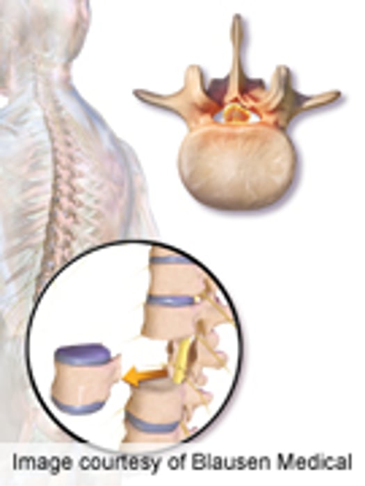 New Cervical Spine Stability Procedure Described