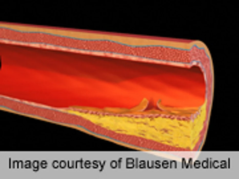 Cadmium Linked to Plaque Development in Older Women