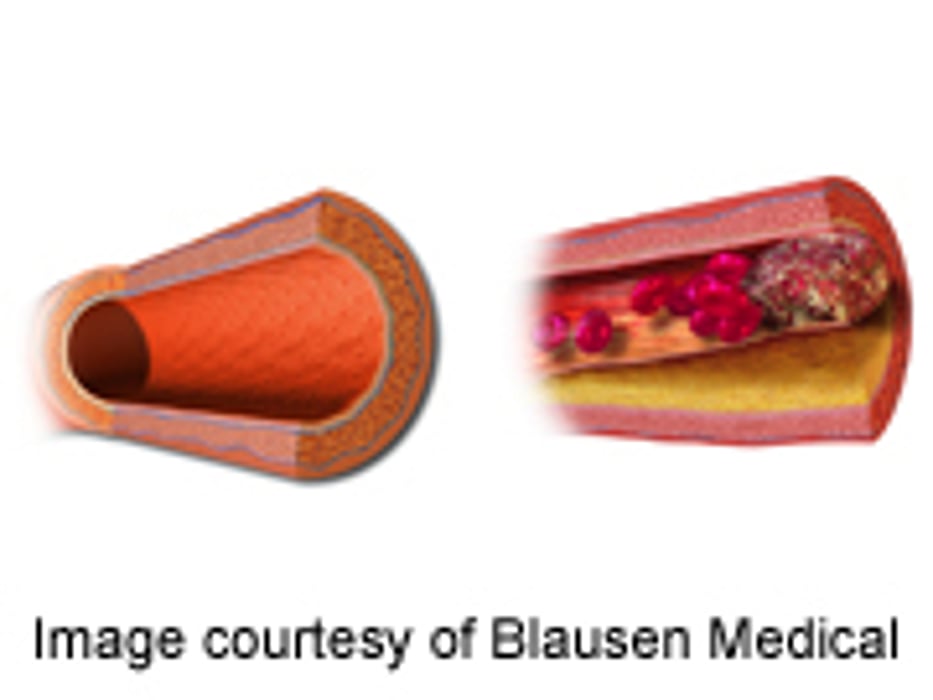 Review Examines Coronary Artery Disease in Women