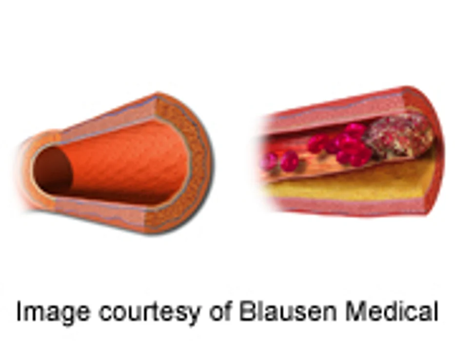 Urinary BPA Increased in Severe Coronary Artery Disease