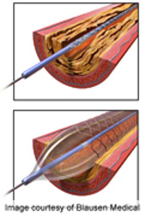 Expensive, Drug-Emitting Stents May Be Overused: Study
