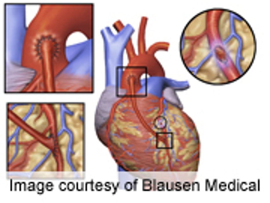 Endoscopic, Open Vein-Graft Harvesting Outcomes Similar