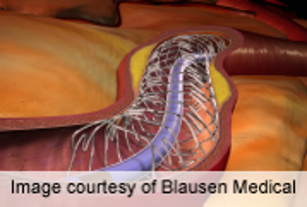 Drug-Eluting Stents Lead to Fewer Adverse Cardiac Events