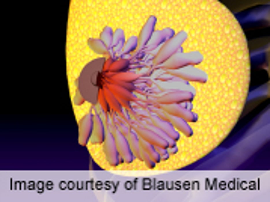 Risks, Management of Atypical Hyperplasia of Breast Discussed