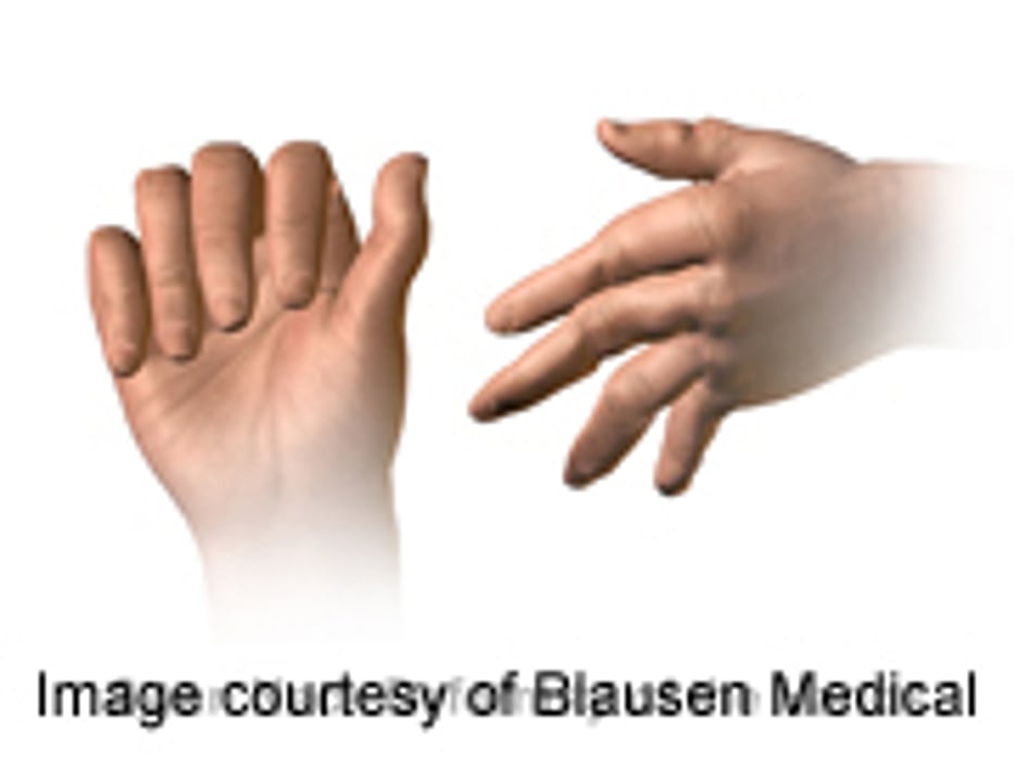 New Pill Might Relieve Severe Rheumatoid Arthritis