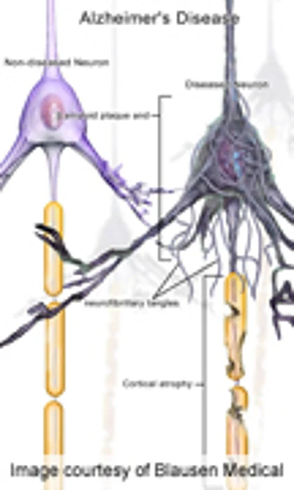 Pathophysiology May Help ID Rare, Early Form of Alzheimer's