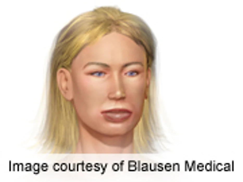 Ecallantide Efficacious for Hereditary Angioedema Attacks