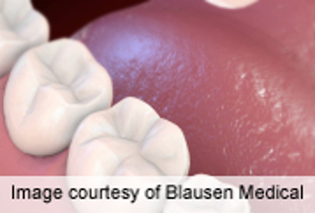 Model Accurately Predicts Risk of Oral Cancer Progression