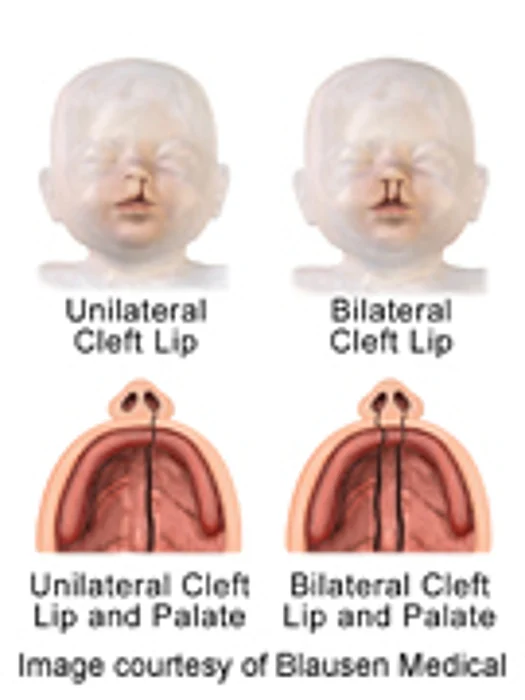 Considerable Variation in Outcomes for Cleft Lip/Palate