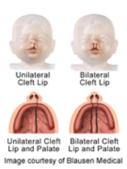 Considerable Variation in Outcomes for Cleft Lip/Palate