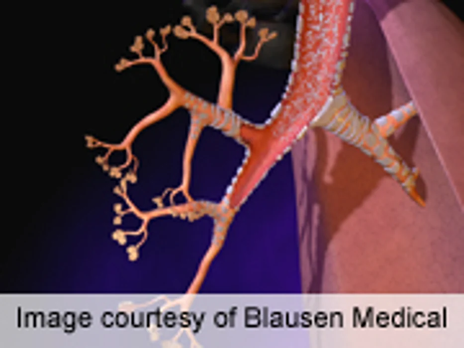 Azithromycin Treats Non-Cystic Fibrosis Bronchiectasis