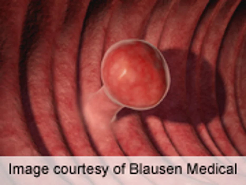 No Benefit Seen for Adjuvant Oxaliplatin in Stage II Colon CA