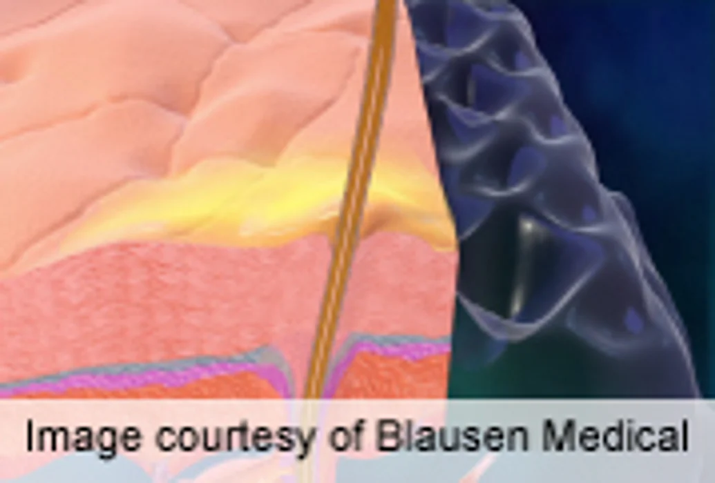 At-Home Diode Laser Effective for Permanent Hair Reduction