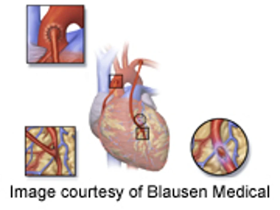 Stroke Risk Higher After Bypass Than Angioplasty: Analysis