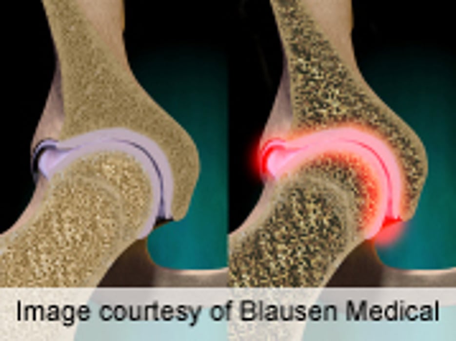 Teen Girls Need Bone Health Advice to Stave Off Osteoporosis