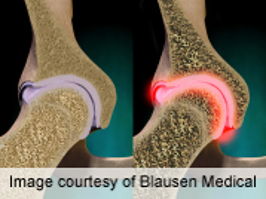 Teen Girls Need Bone Health Advice to Stave Off Osteoporosis