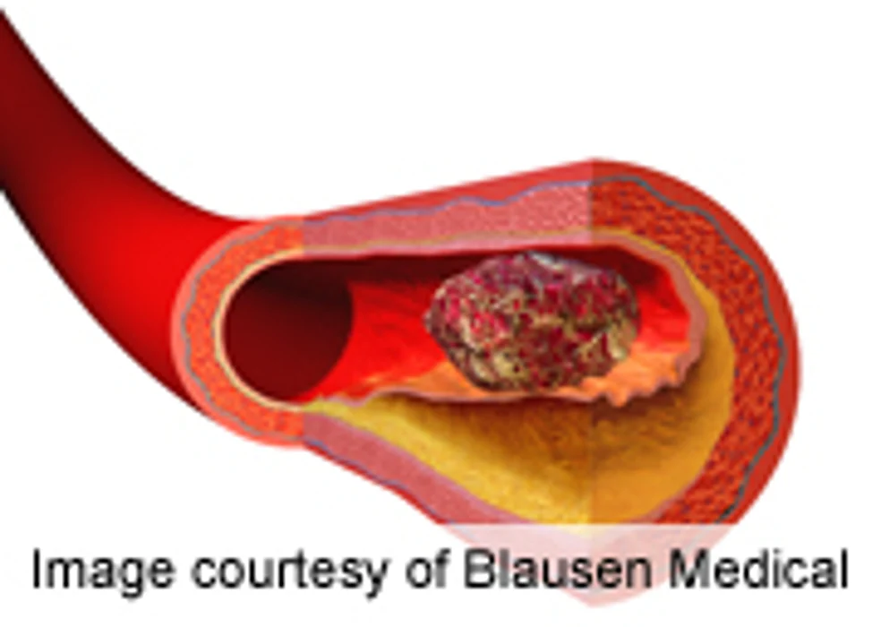 Stress Causes Lower INR in VTE Patients Not on Blood Thinners
