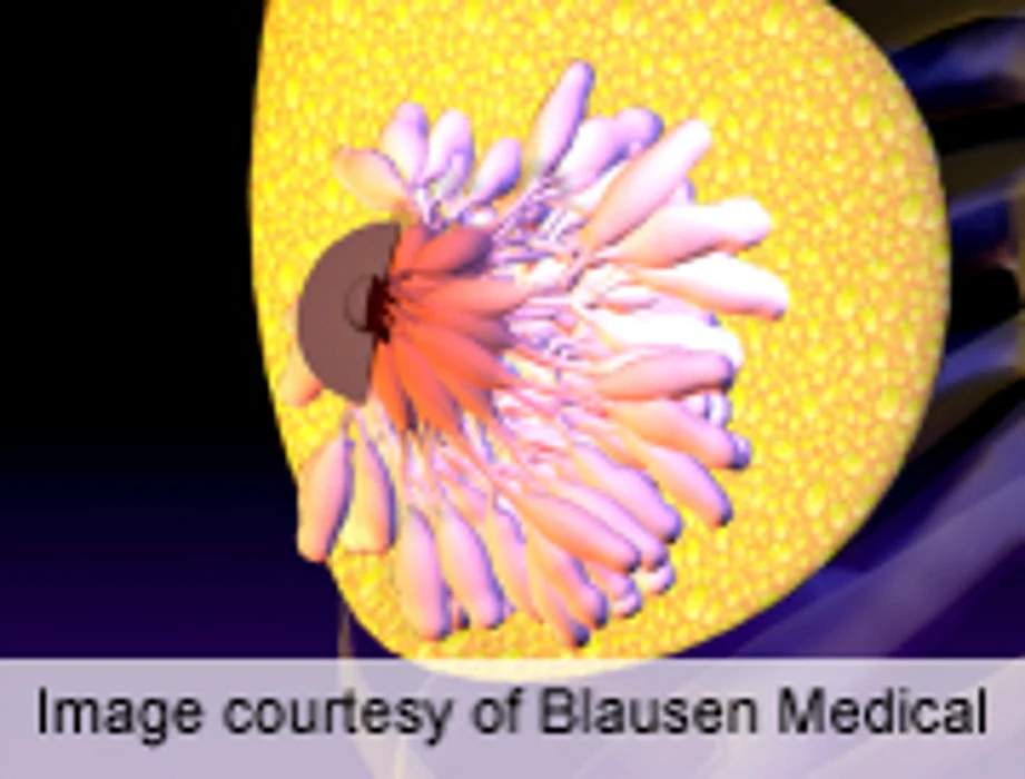 Poor Survival for Obese Women With HR+ Breast Cancer