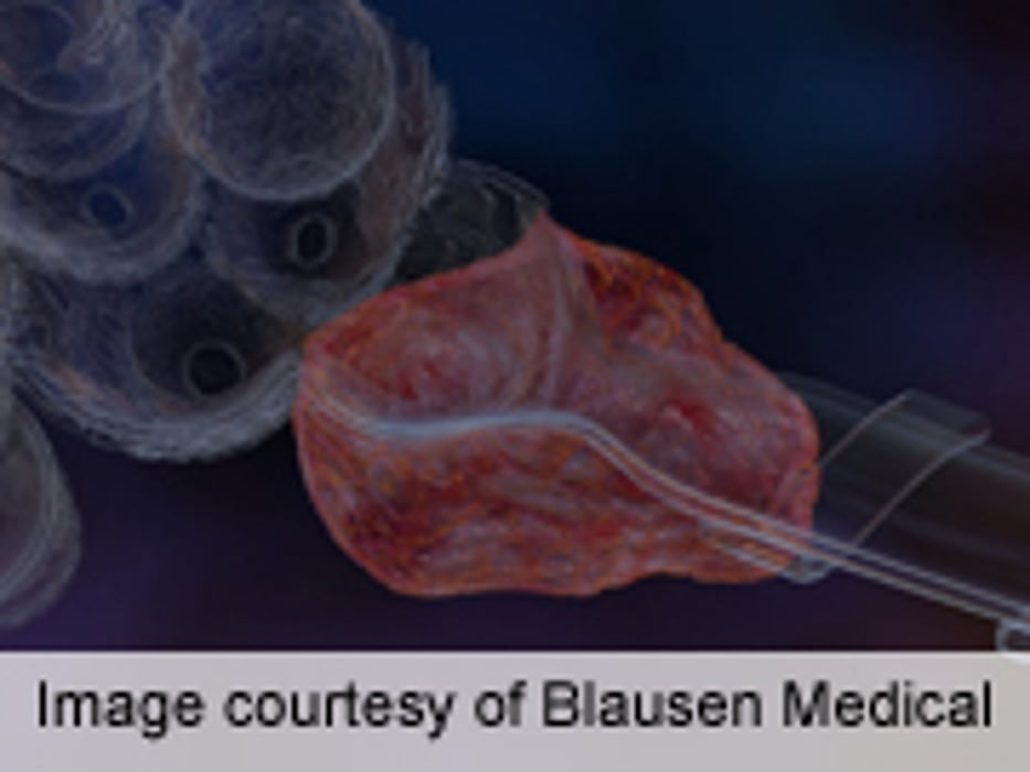 New Treatment Available for Repeated Occlusion of Arteries