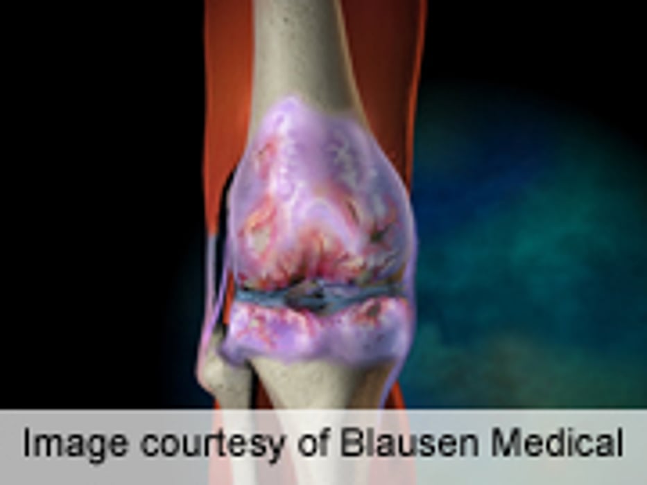 Pharmacist-Led Intervention Benefits Knee Osteoarthritis