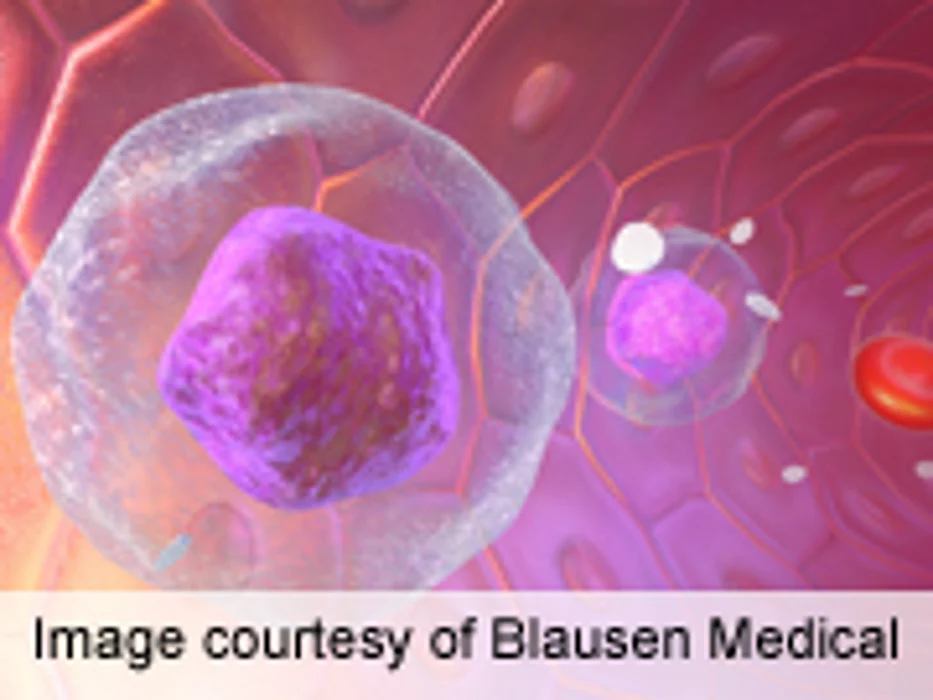 Particular Donor Genotype Lowers Leukemia Relapse Rate