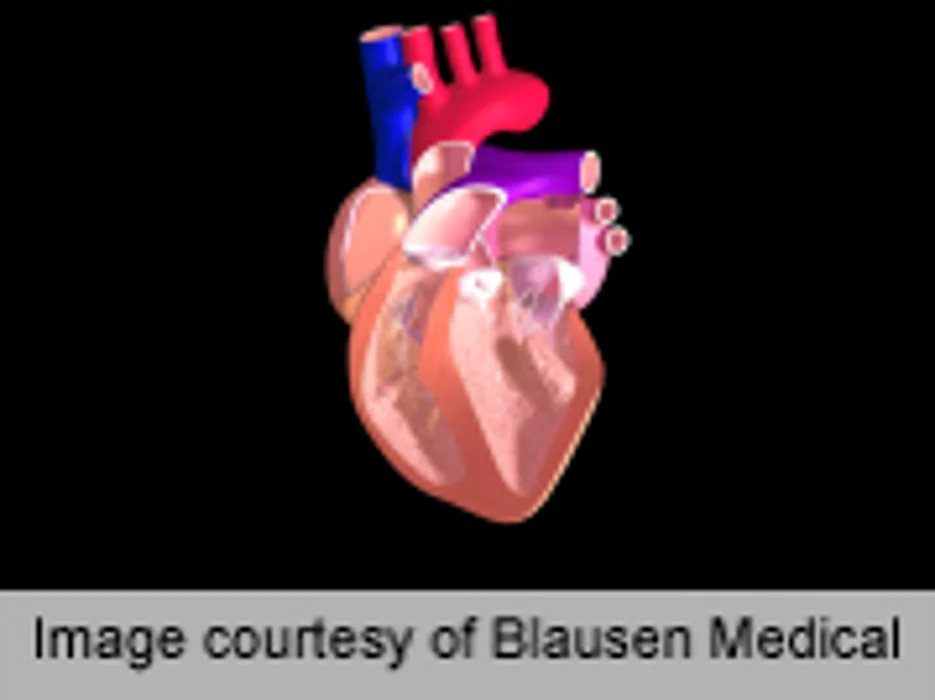 Prognosis Better for Exercise-Linked Cardiac Arrest
