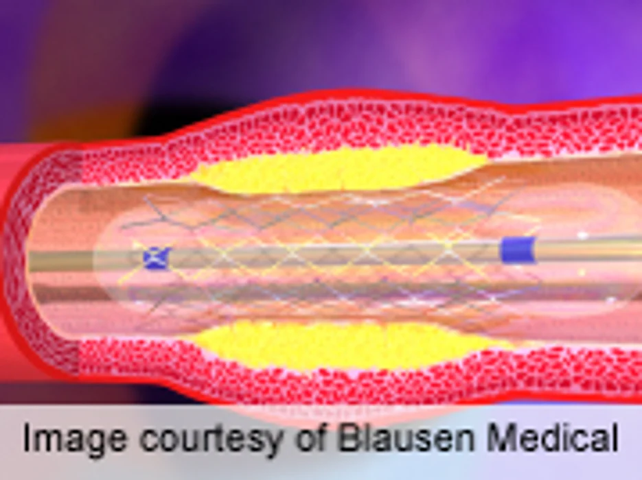 No 30-Day Mortality Reduction With Intraaortic Balloon Pump