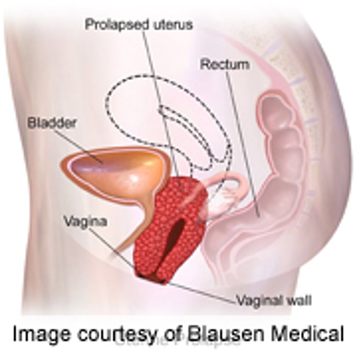 Colpocleisis Deemed Safe for Advanced Pelvic Organ Prolapse