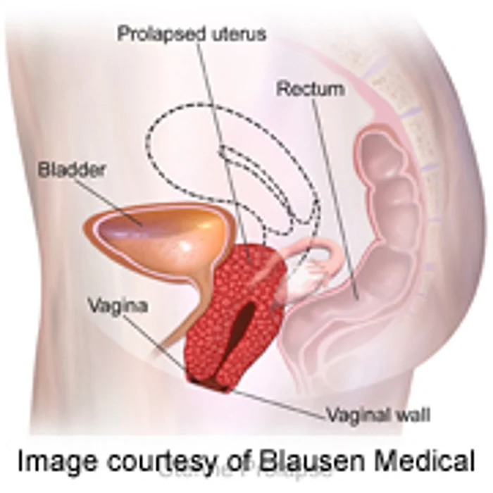 Colpocleisis Deemed Safe for Advanced Pelvic Organ Prolapse