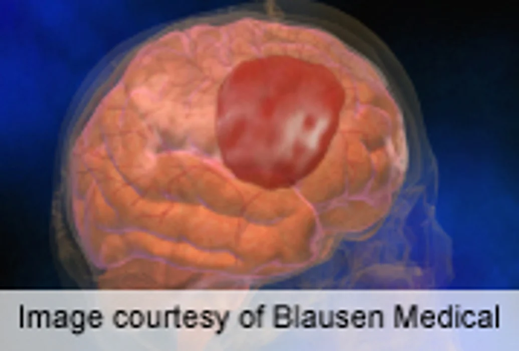 Quitting Smoking Cuts Elevated Subarachnoid Hemorrhage Risk
