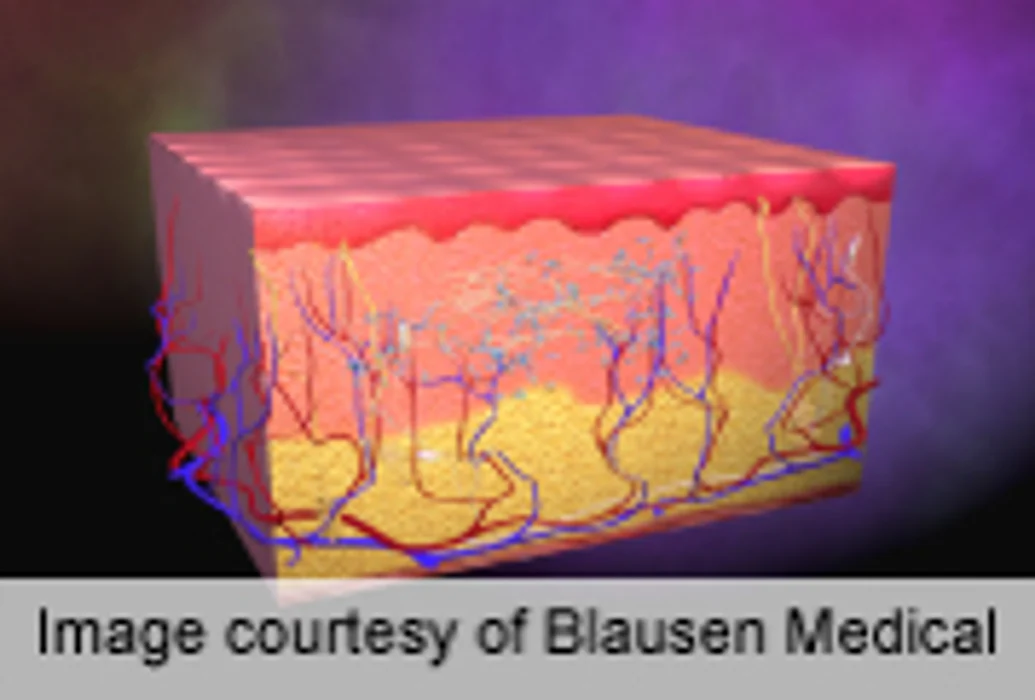 Imaging Device Quantifies Change in Port Wine Stains