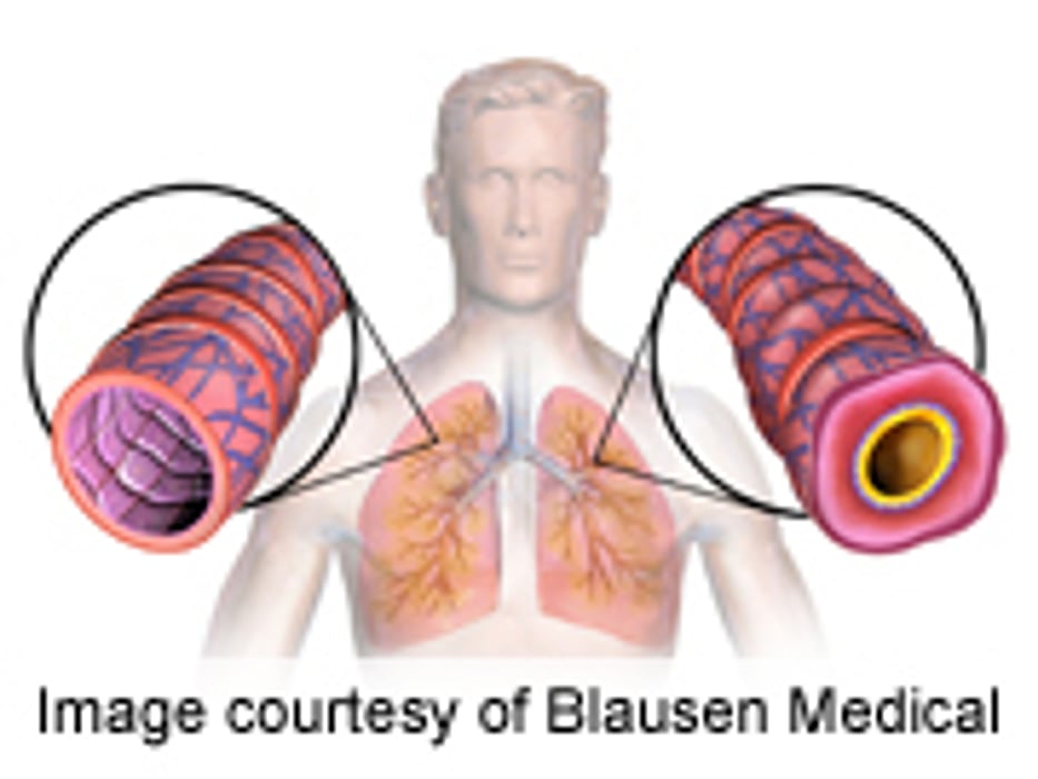 Language Barrier Linked to Poorer Asthma Outcomes