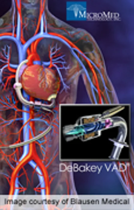Ventricular Assist Device Beneficial in Youth Heart Failure