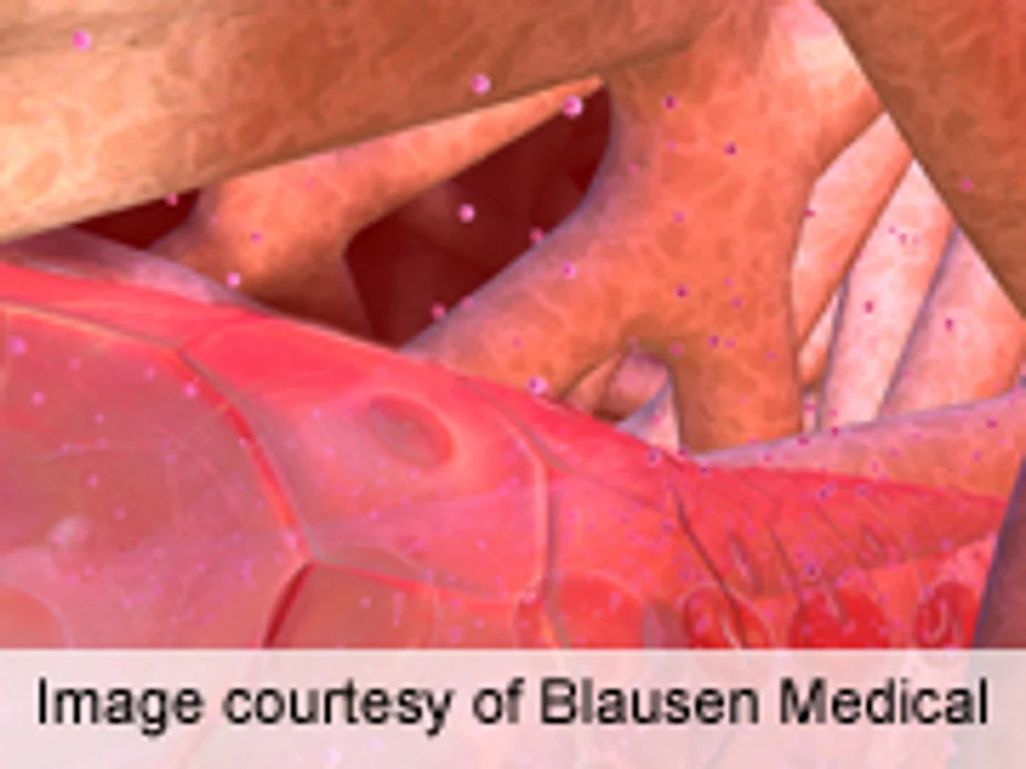 Prolonged Dexamethasone Cuts Delayed Nausea After Chemo