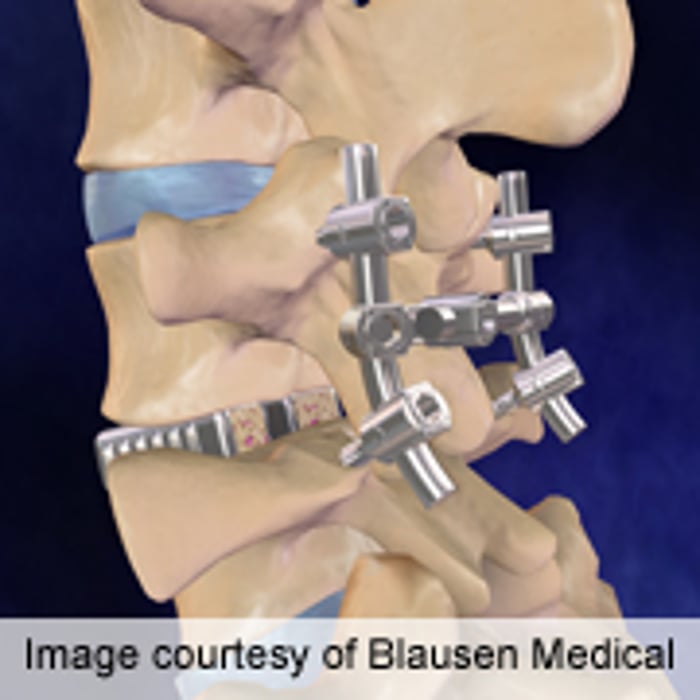 No Increased Risk of Stroke After Spinal Fusion Surgery